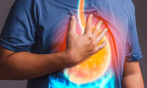 Kaj je zgaga oz. refluks?